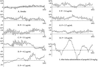 Brain Mechanisms during Course of Anesthesia: What We Know from EEG Changes during Induction and Recovery